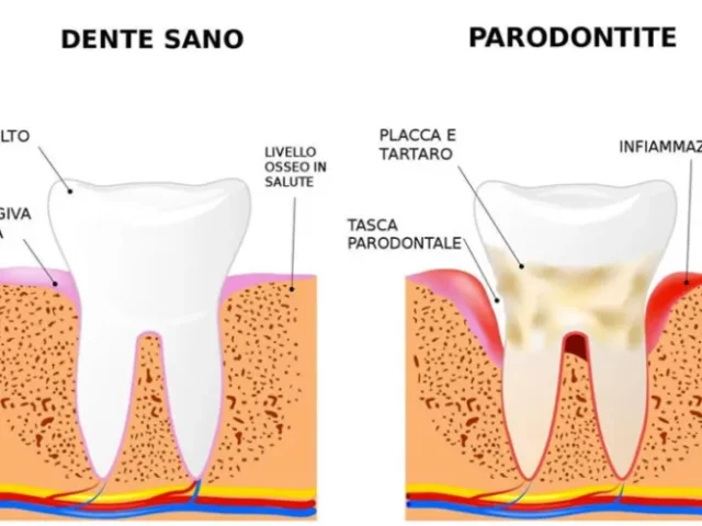 Cause e conseguenze della Piorrea (Parodontite)